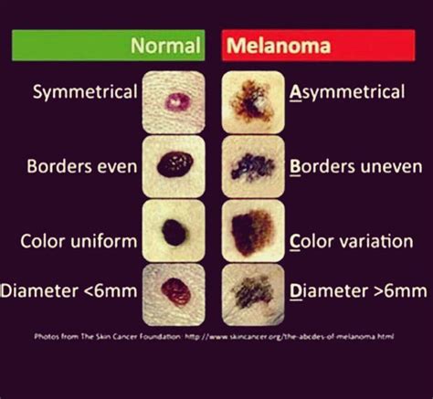 regular mole vs melanoma
